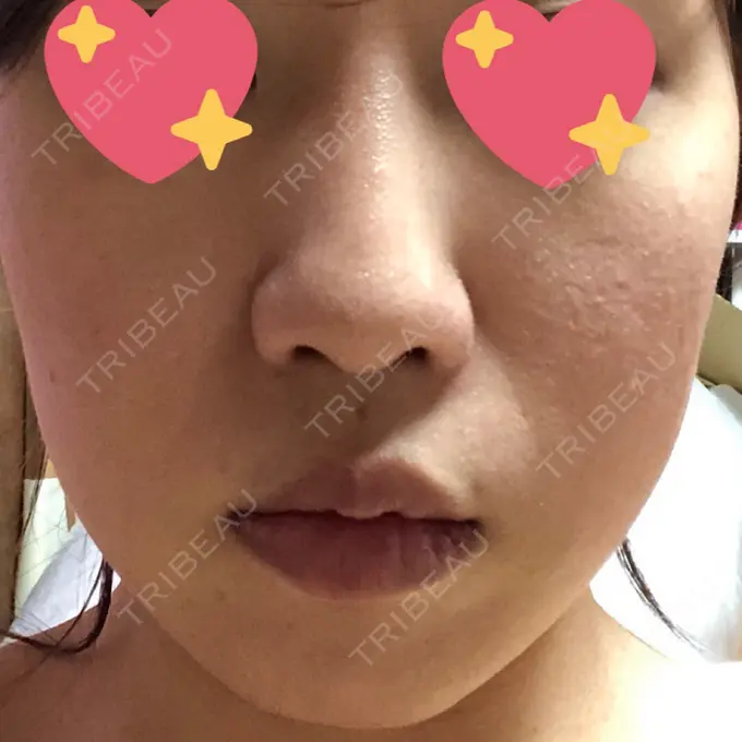 糸リフト / バッカルファット除去 湘南美容クリニック 高松院 DAY 49 メイン用