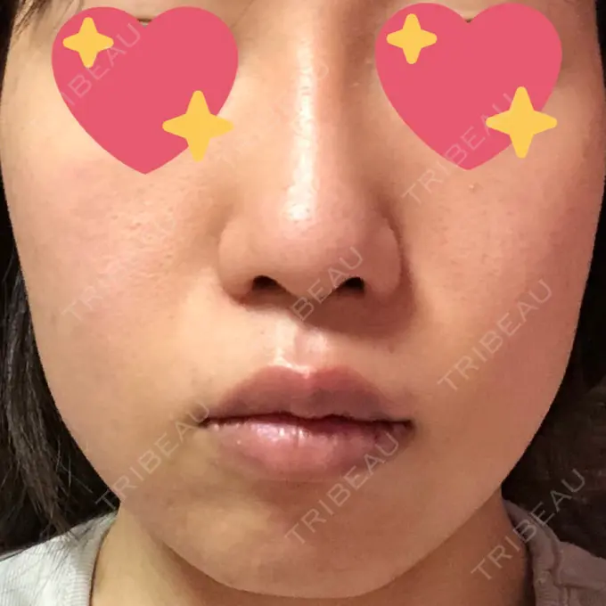 糸リフト / バッカルファット除去 湘南美容クリニック 高松院 AFTER メイン用