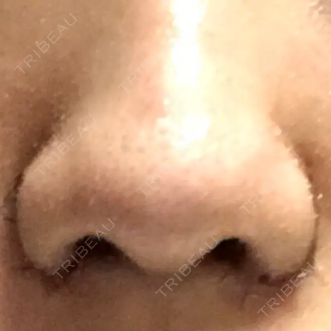 小鼻縮小（切開） 共立美容外科 高松院 DAY 6 メイン用