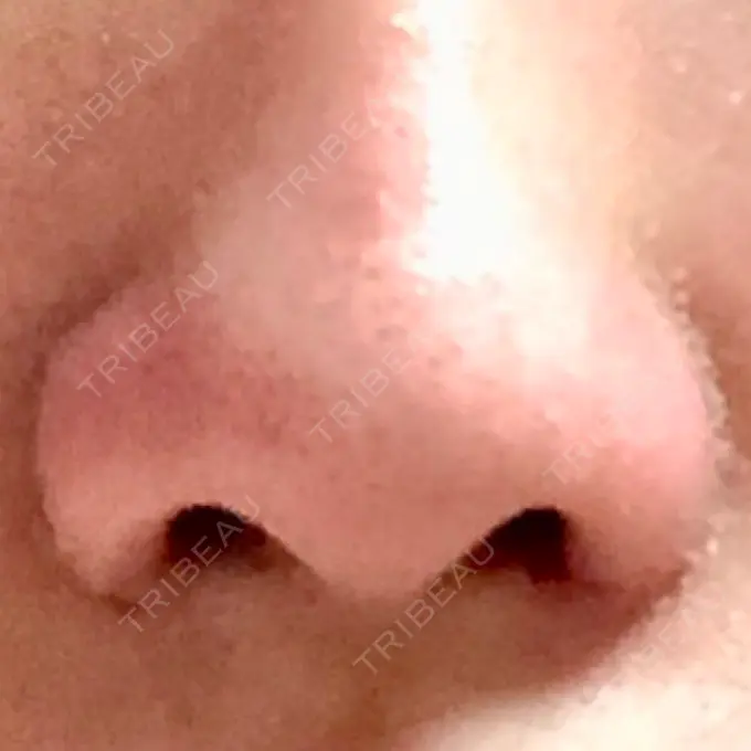 小鼻縮小（切開） 共立美容外科 高松院 DAY 7 メイン用