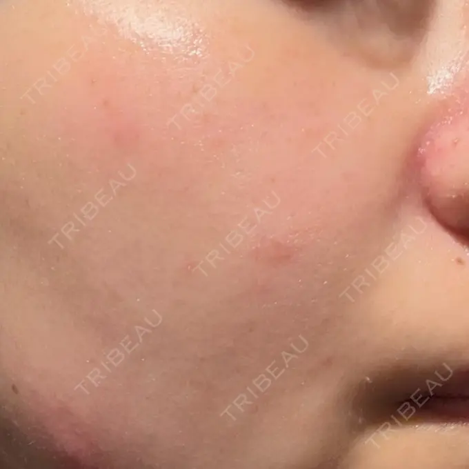 エレクトロポレーション / 毛穴洗浄（ハイドラフェイシャルなど） 表参道ウィズ・クリニック AFTER メイン用