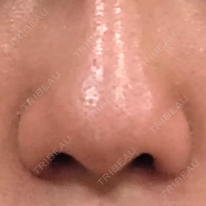 小鼻縮小（切開） 共立美容外科 高松院 DAY 10 メイン用