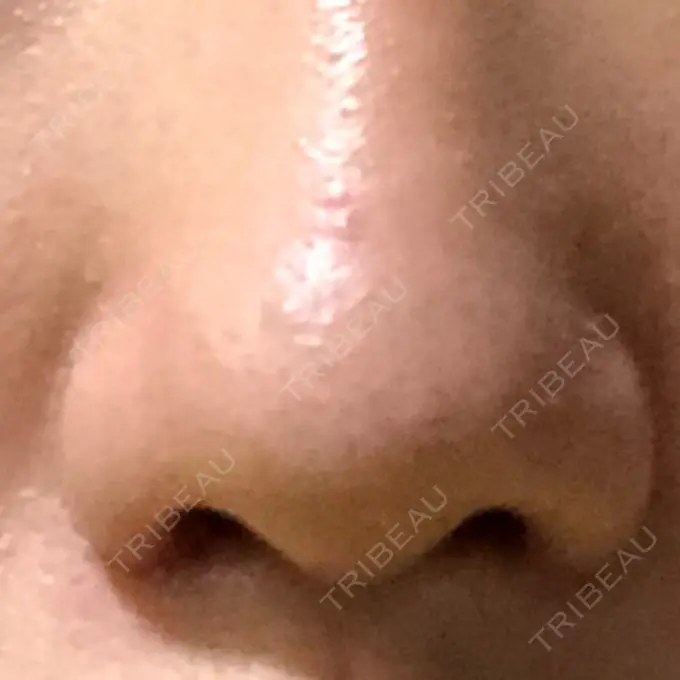 小鼻縮小（切開） 共立美容外科 高松院 DAY 14 メイン用