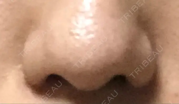 小鼻縮小（切開） 共立美容外科 高松院 DAY 30 メイン用