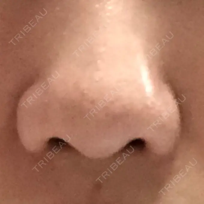 小鼻縮小（切開） 共立美容外科 高松院 DAY 59 メイン用