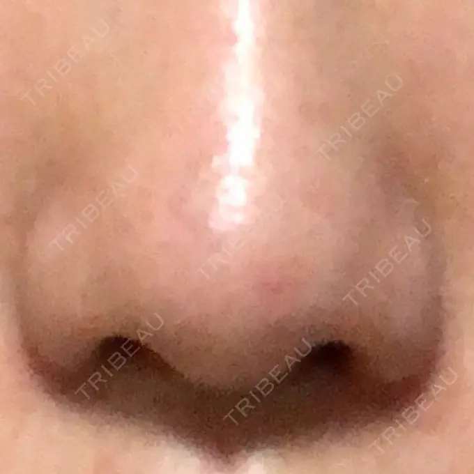 小鼻縮小（切開） 共立美容外科 高松院 DAY 90 メイン用
