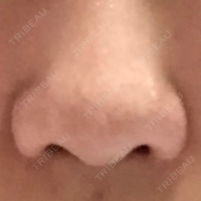 小鼻縮小（切開） 共立美容外科 高松院 AFTER メイン用