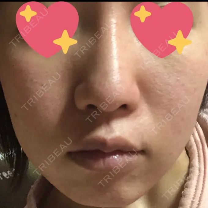 糸リフト / バッカルファット除去 湘南美容クリニック 高松院 DAY 50 メイン用