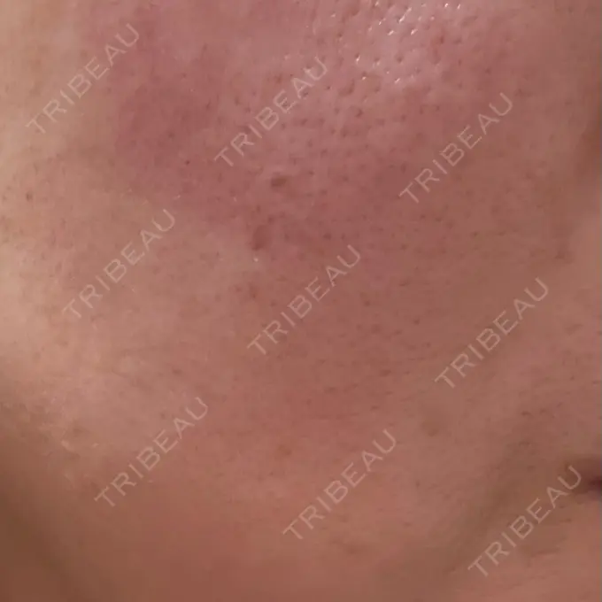 美肌レーザー / 美白レーザー / レーザートーニング（美白・肝斑） 銀座みゆき通り美容外科 大阪梅田院 DAY 0 メイン用