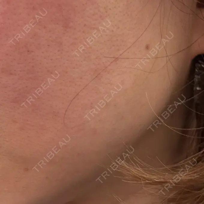 美肌レーザー / 美白レーザー / レーザートーニング（美白・肝斑） 銀座みゆき通り美容外科 大阪梅田院 DAY 0 メイン用