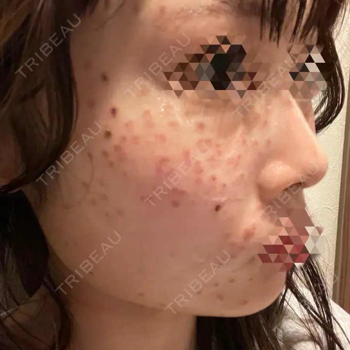 ほくろ・いぼ切除（肌） 東京シルククリニック 新宿院 DAY 0 メイン用