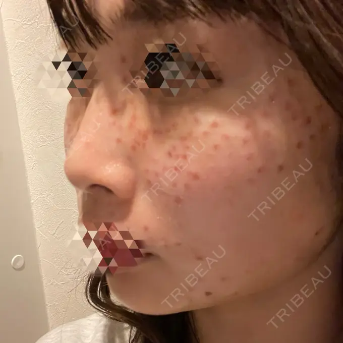 ほくろ・いぼ切除（肌） 東京シルククリニック 新宿院 DAY 0 メイン用