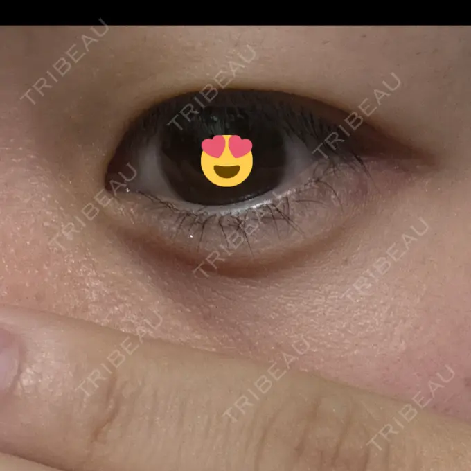 ヒアルロン酸注入（涙袋） YBC横浜美容外科 立川院 AFTER メイン用