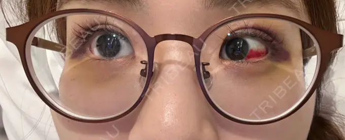 二重埋没 WOM CLINIC GINZA （ワム クリニック ギンザ） DAY 15 メイン用