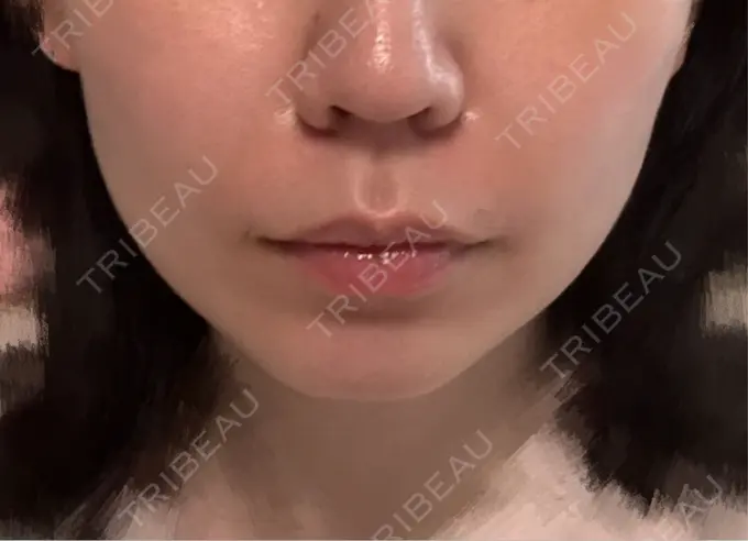 ヒアルロン酸注入（鼻翼基部） Brandnew Beauty Clinic AFTER メイン用