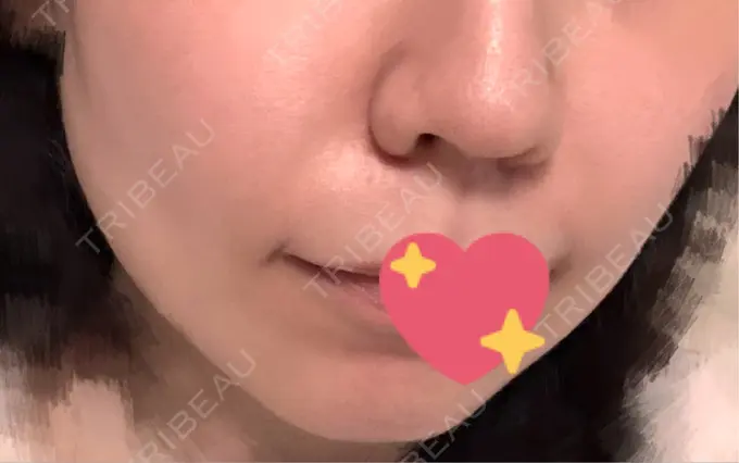 ヒアルロン酸注入（鼻翼基部） Brandnew Beauty Clinic DAY 9 メイン用
