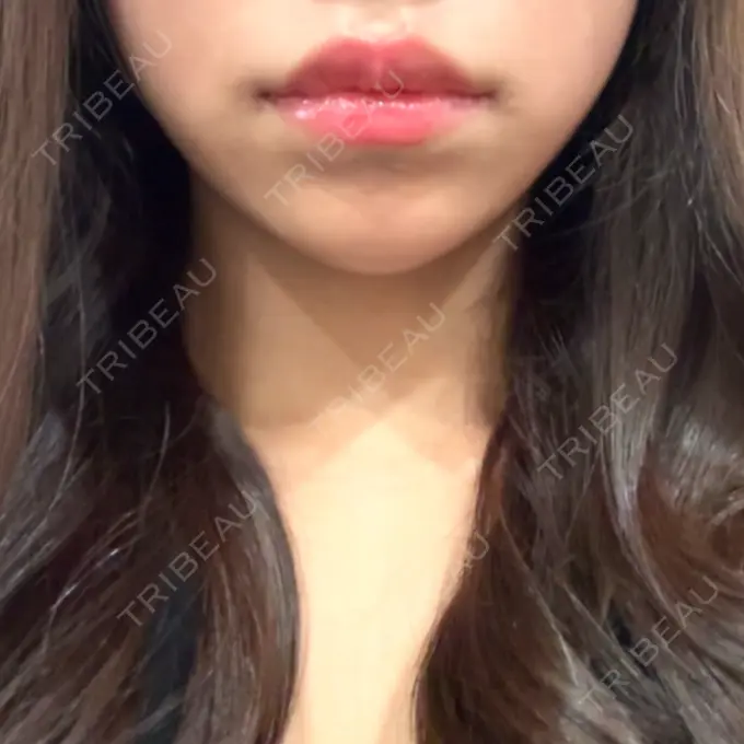 ヒアルロン酸注入（あご） / ヒアルロン酸注入（唇） アリエル美容クリニック 水戸院 AFTER メイン用