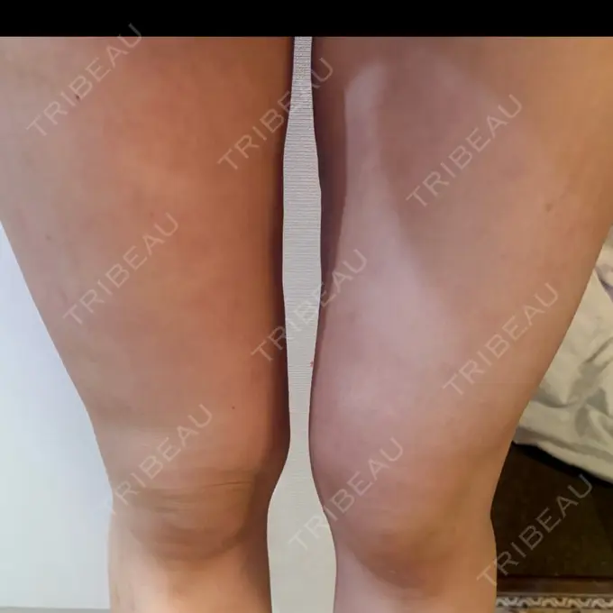 脂肪吸引（脚） / 脂肪吸引（お尻） 湘南美容クリニック 名古屋駅本院 DAY 22 メイン用