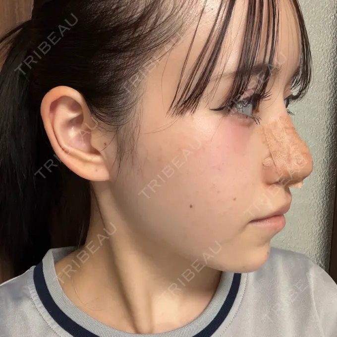 隆鼻術 / 軟骨移植 / 鼻尖形成（非切開） / 鼻中隔延長（非切開） WOM CLINIC GINZA （ワム クリニック ギンザ） DAY 10 メイン用