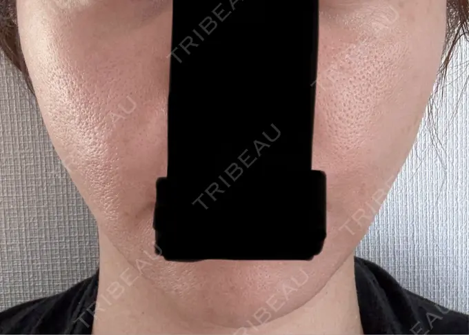 デンシティ 城本クリニック 新宿院 AFTER メイン用