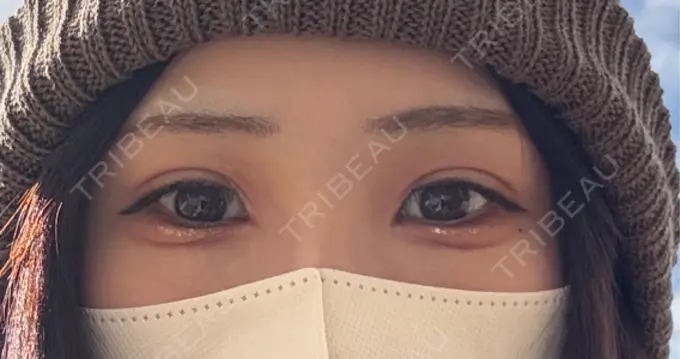 二重埋没 アリエル美容クリニック 横浜院 DAY 28 メイン用