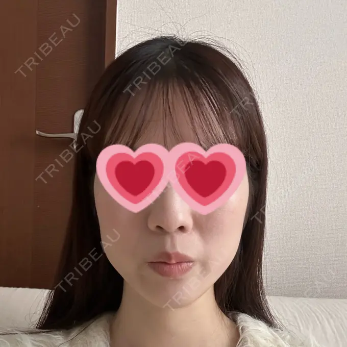 糸リフト / ボトックス（エラ・小顔） アリエル美容クリニック 横浜院 AFTER メイン用