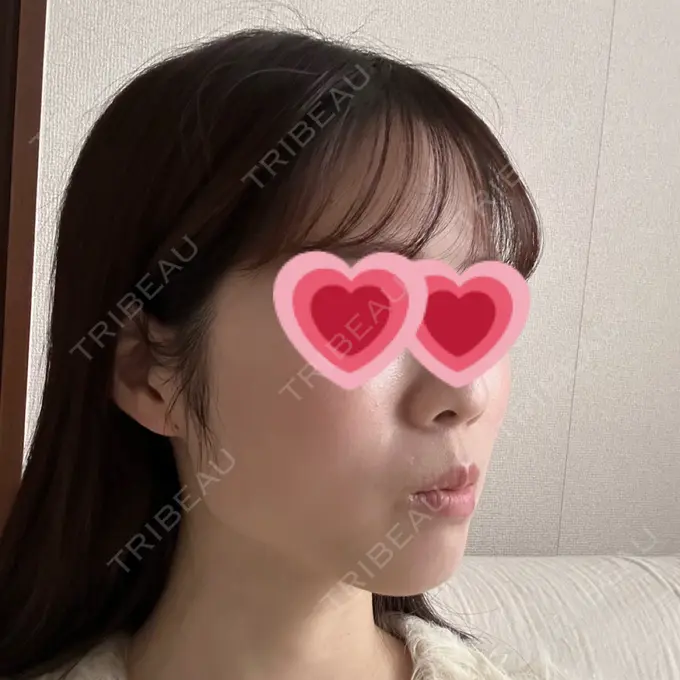 糸リフト / ボトックス（エラ・小顔） アリエル美容クリニック 横浜院 DAY 28 メイン用