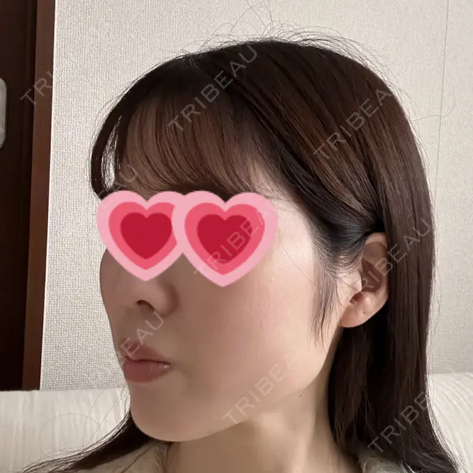 糸リフト / ボトックス（エラ・小顔） アリエル美容クリニック 横浜院 DAY 28 メイン用