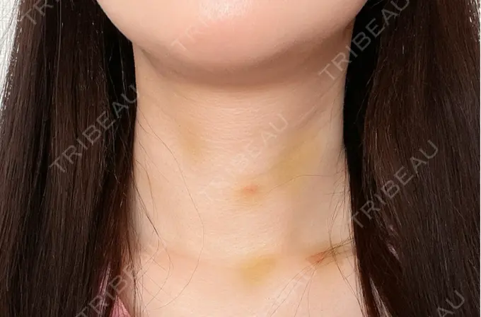 ヒアルロン酸注入（首） 銀座TSUBAKIクリニック DAY 5 メイン用