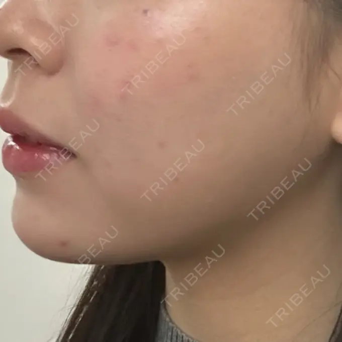 ボトックス（エラ・小顔） / ボトックス（首） おおかみ美容のクリニック 新宿院 AFTER メイン用