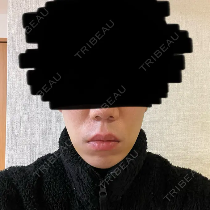 糸リフト / 脂肪吸引（顔） 東京ココセランクリニック DAY 7 メイン用