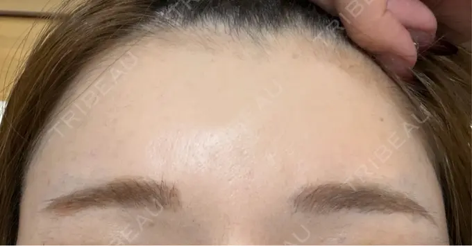 ボトックス（あご） / ボトックス（口角） / ボトックス（肩） / ボトックス（眉間） / ボトックス（首） DMTC CLINIC 日本橋院 AFTER メイン用