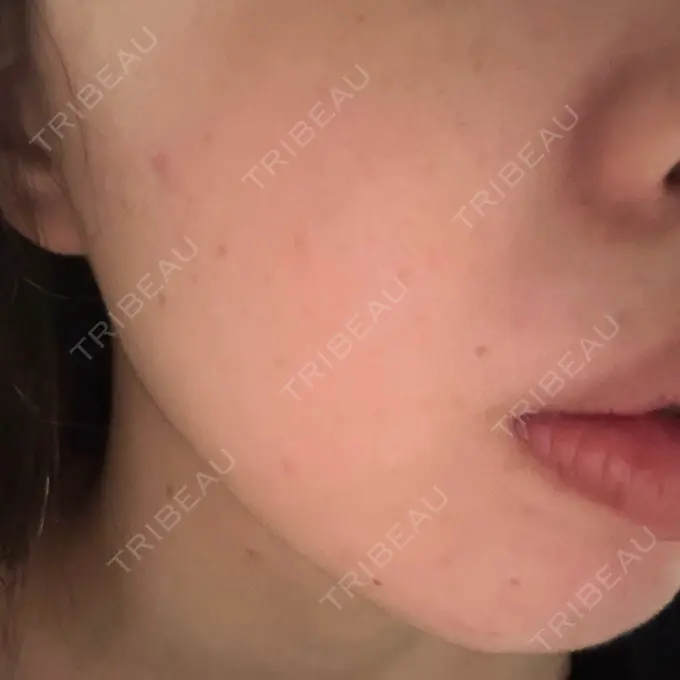 ルメッカ ルラ美容クリニック 千葉院 / ルラスキンクリニック 千葉院 AFTER メイン用