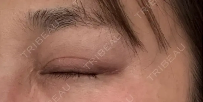 ボトックス（目尻） 札幌TAクリニック DAY 3 メイン用