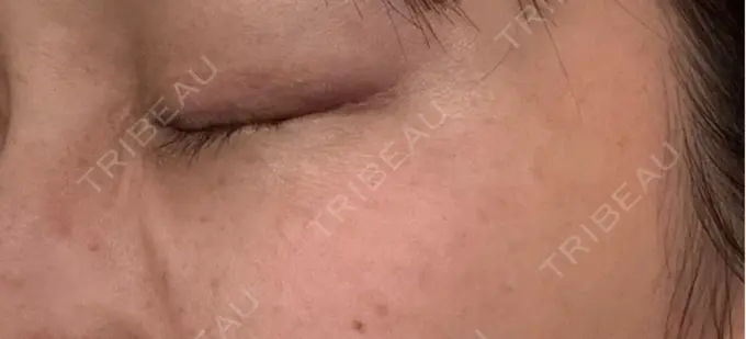 ボトックス（目尻） 札幌TAクリニック DAY 4 メイン用