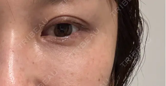 ボトックス（目尻） 札幌TAクリニック DAY 5 メイン用