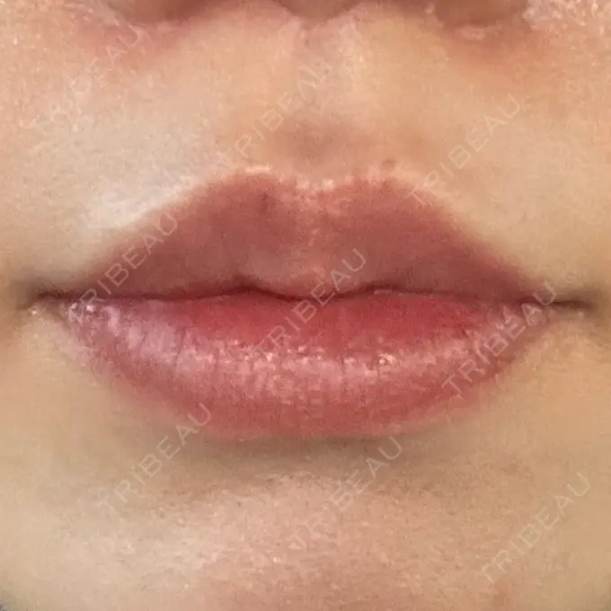 人中短縮 eクリニック 大阪梅田 西日本統括院 DAY 99 メイン用