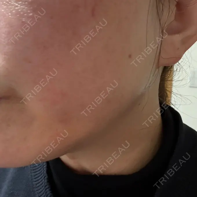 美肌レーザー / 美白レーザー / レーザートーニング（美白・肝斑） 銀座みゆき通り美容外科 大阪梅田院 DAY 0 メイン用