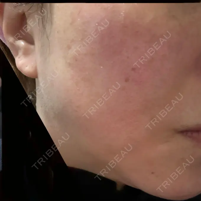 美肌レーザー / 美白レーザー / レーザートーニング（美白・肝斑） 銀座みゆき通り美容外科 大阪梅田院 DAY 0 メイン用