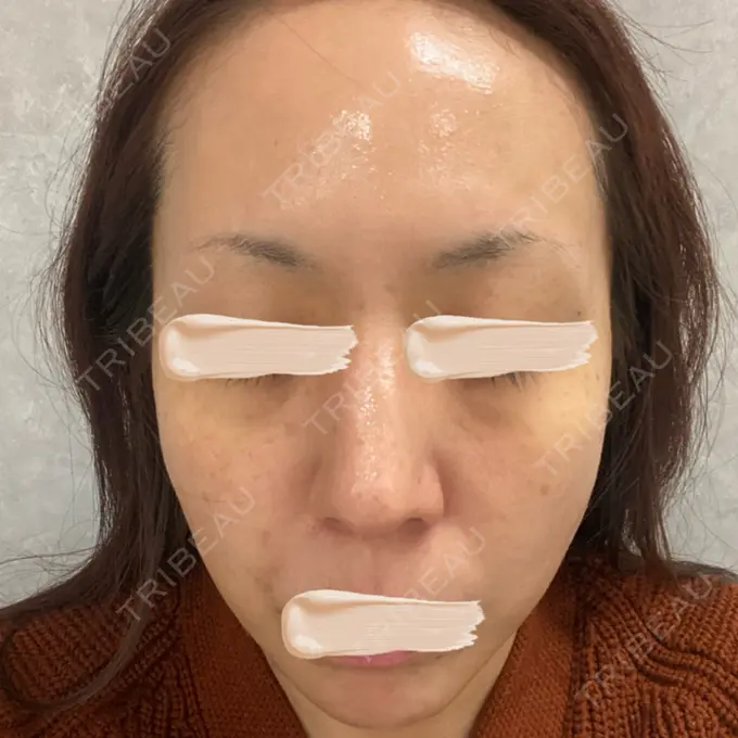 ピーリング（ニキビ・毛穴） / LDM・インテンスウルトラ Chloe Cheongdam Clinic （クロエチョンダムクリニック） AFTER メイン用