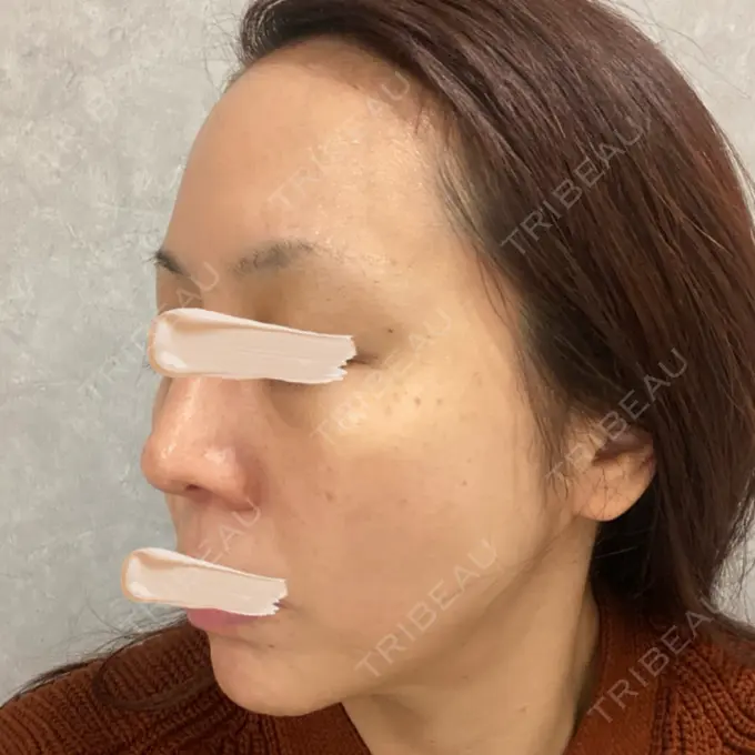 ピーリング（ニキビ・毛穴） / LDM・インテンスウルトラ Chloe Cheongdam Clinic （クロエチョンダムクリニック） DAY 0 メイン用