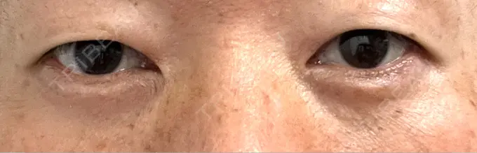 クマ治療 / 下まぶたの脂肪取り ROOTS Clinic AFTER メイン用