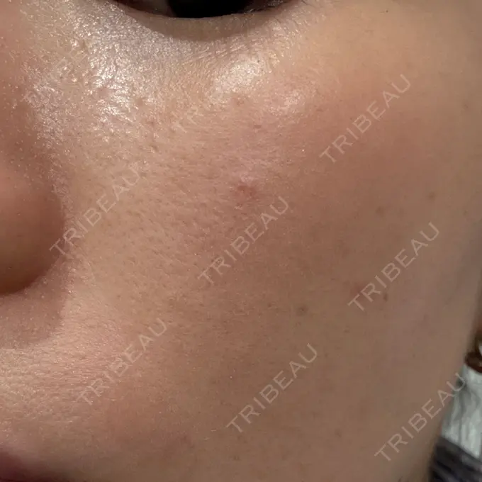 ルメッカ MIO CLINIC 梅田院 AFTER メイン用