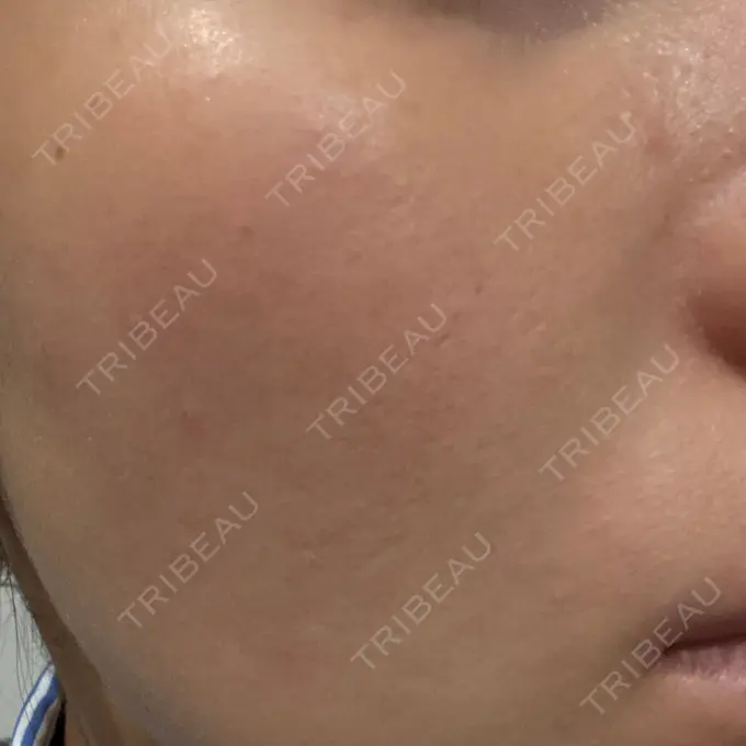 ルメッカ MIO CLINIC 梅田院 DAY 12 メイン用