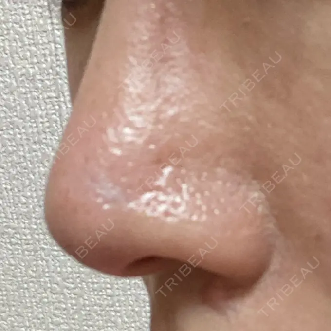 アグネス 日本美容・医療クリニック 六本木院 AFTER メイン用