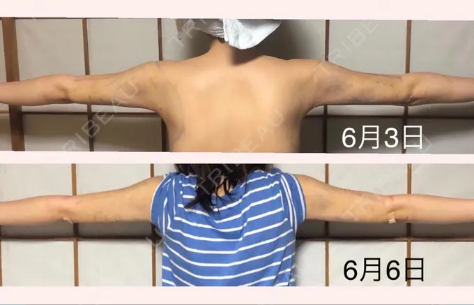 脂肪吸引（二の腕） ヨンセスリムライン DAY 9 メイン用