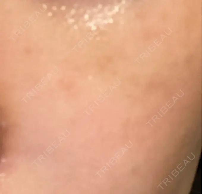 ヒアルロン酸注入（目の下） / ヒアルロン酸注入（鼻翼基部） 湘南美容クリニック 博多院 DAY 17 メイン用