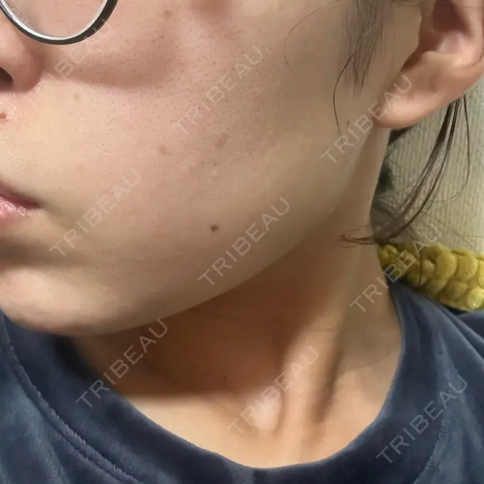 ピーリング（ニキビ・毛穴） 大美会クリニック 岡山院 AFTER メイン用