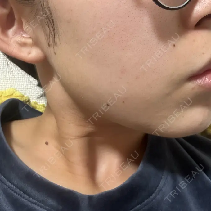 ピーリング（ニキビ・毛穴） 大美会クリニック 岡山院 DAY 8 メイン用