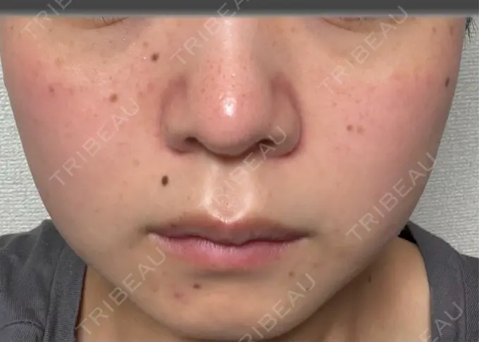 イオン導入 / ピーリング（ハリ・ツヤ） / ルメッカ ルラ美容クリニック 仙台院 / ルラスキンクリニック 仙台院 DAY 1 メイン用